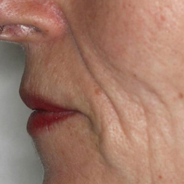 Antes de la operación de pómulos