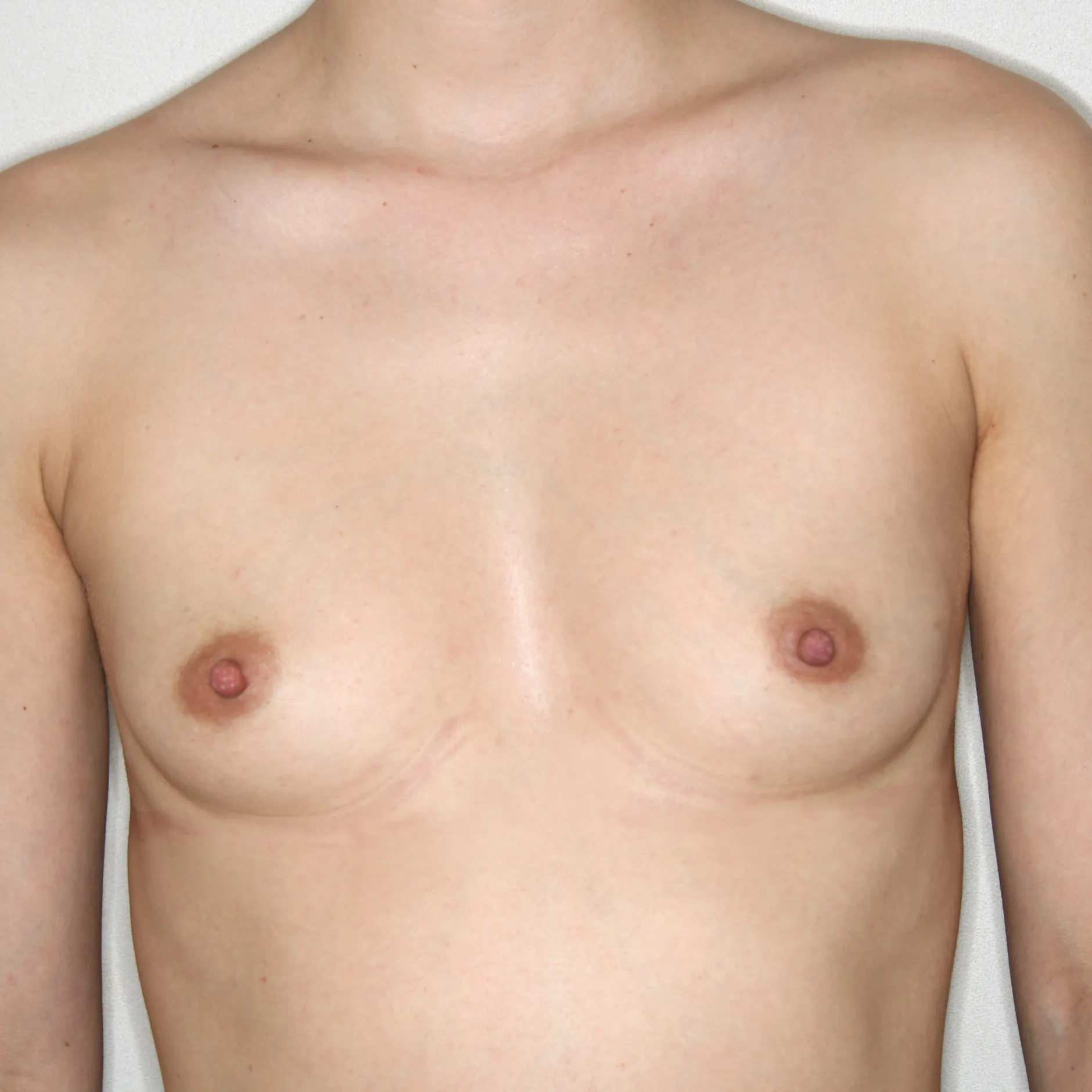 Antes del aumento mamario