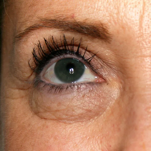 Blefaroplastia en Barcelona: párpados antes de la cirugía — caso real de Vila Group Clinic