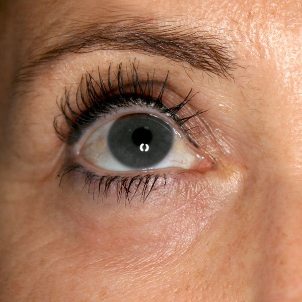 Después de la blefaroplastia