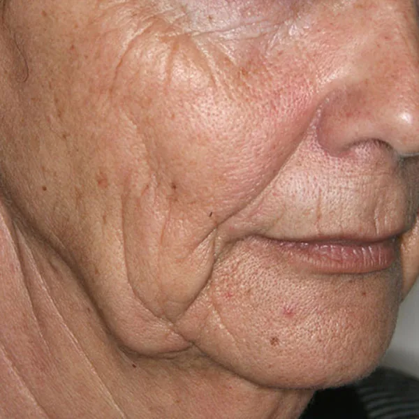 Lifting facial en Barcelona: rostro antes de la intervención — caso real de Vila Group Clinic