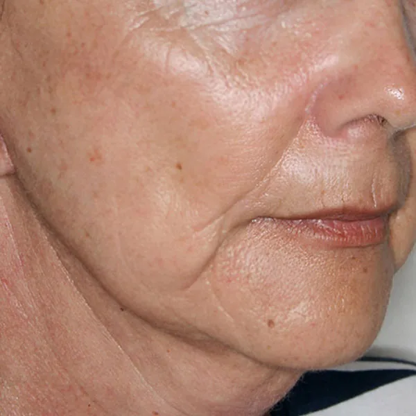 Lifting facial en Barcelona: resultado a los 8 meses — caso real de Vila Group Clinic